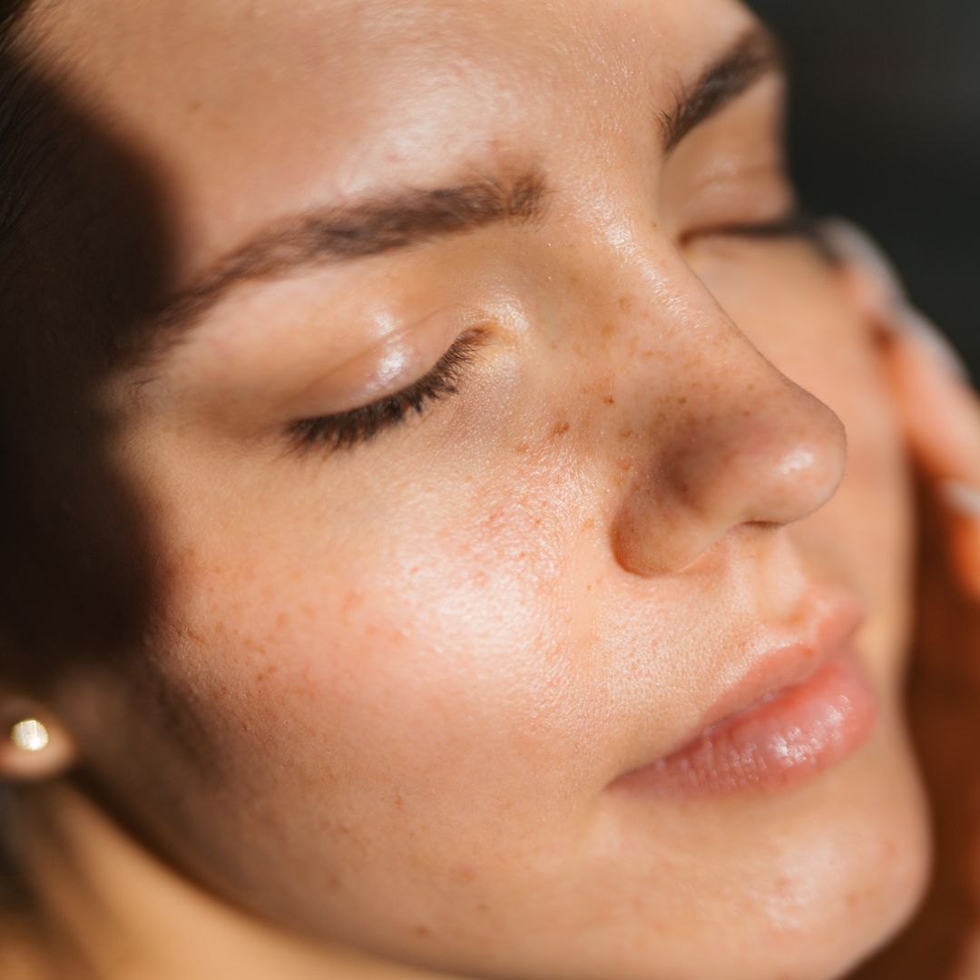 This 'preventative' laser treatment took me back to my 20-year-old skin